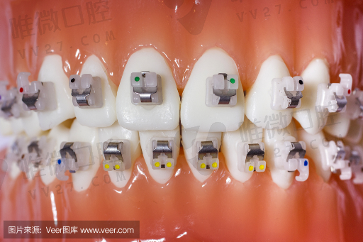 吸附式假牙和纯钛的区别,钛合金假牙是烤瓷牙吗(图1)